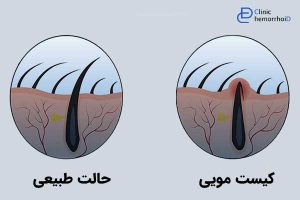 اصلاح مو برای پیشگیری از کیست مویی