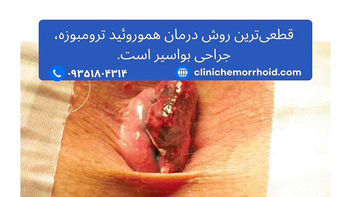 درمان بواسیر هموروئید ترامبوزه