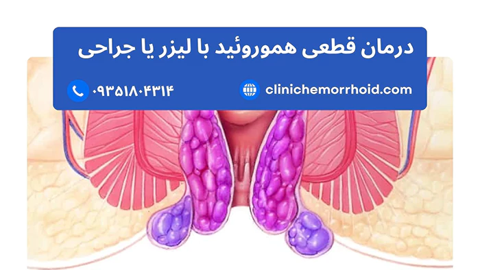 درمان قطعی هموروئید