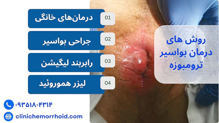 روش‌های درمان بواسیر ترامبوزه