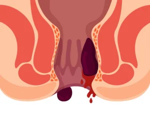 هموروئید ترامبوزه