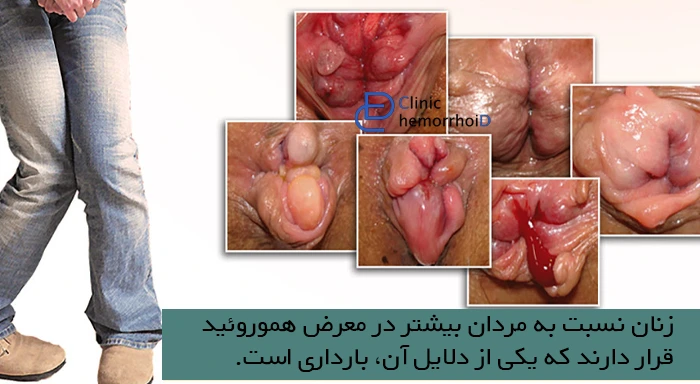 بواسیر در زنان