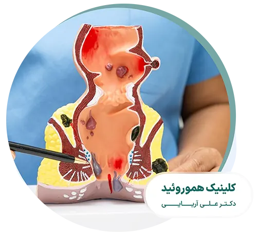 تشخیص و درمان هموروئید