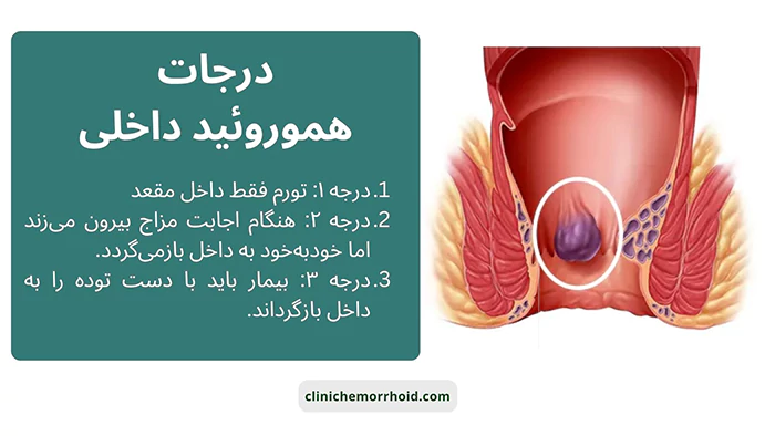 درحات هموروئید داخلی