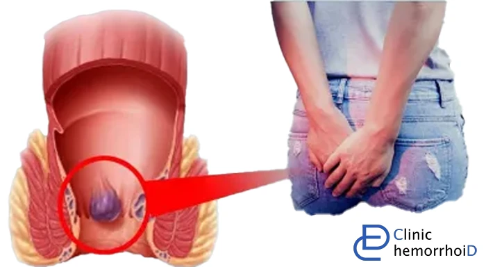 درمان بواسیر زنان