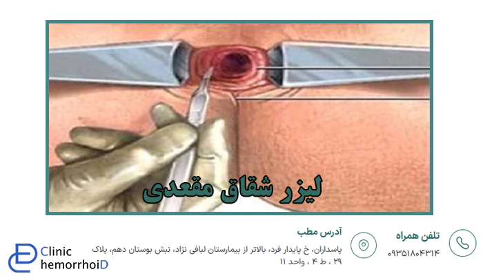 درمان شقاق مقعدی با لیزر