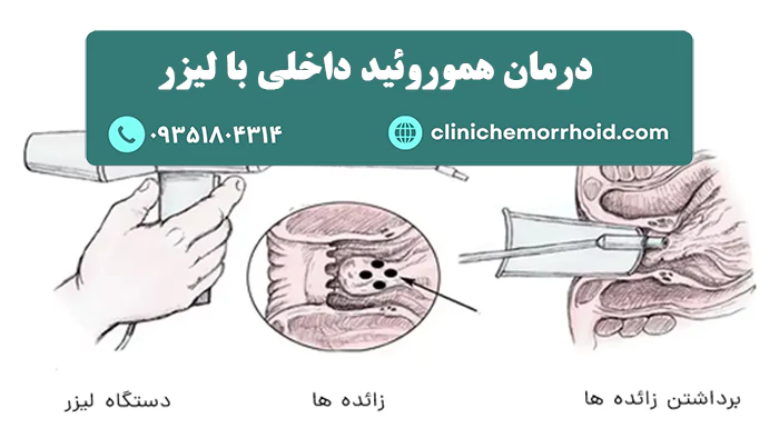 درمان هموروئید داخلی با لیزر