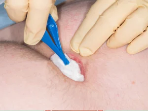 درمان کیست مویی با لیزر در کلینیک آریایی