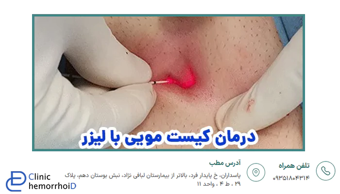 درمان کیست مویی با لیزر