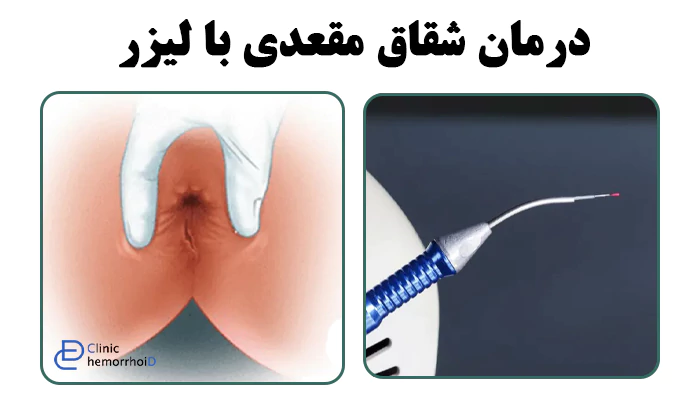 شقاق مقعدی با لیزر