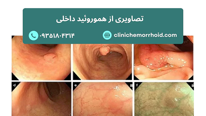 عکس هموروئید داخلی