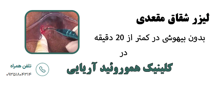 لیزر شقاق مقعدی در کلینیک هموروئید