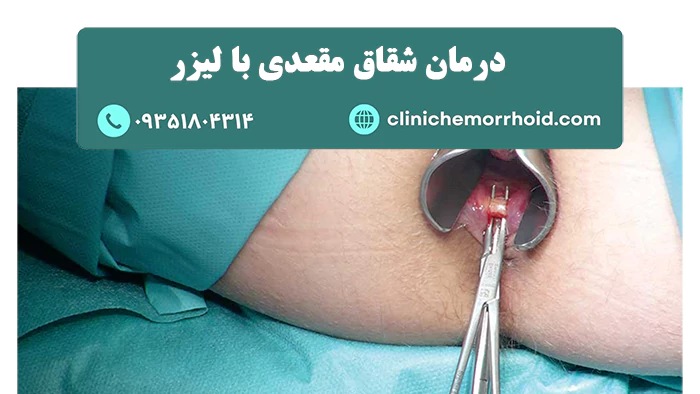 لیزر شقاق مقعدی چیست
