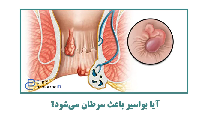 آیا بواسیر باعث سرطان می‌شود