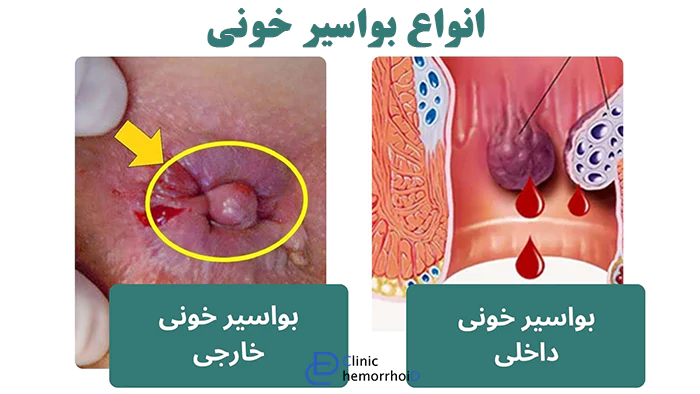 انواع بواسیر خونی