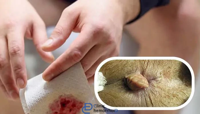 بواسیر ترکیده