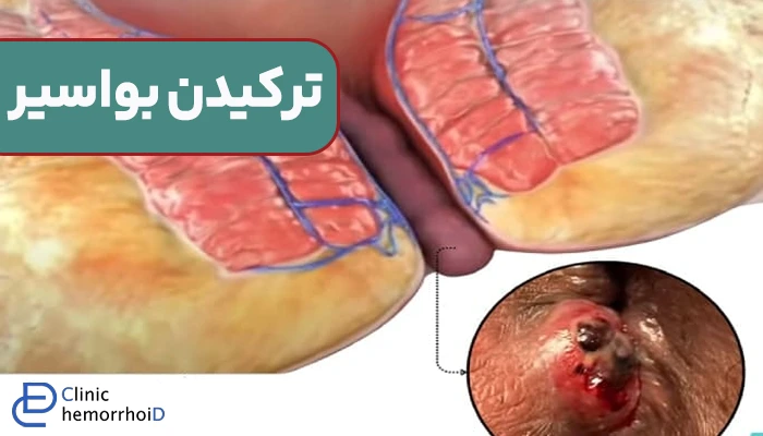 ترکیدن بواسیر