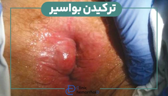 ترکیدن هموروئید