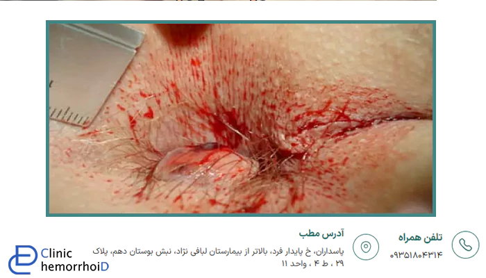 درمان بواسیر خونی