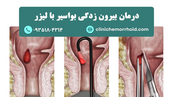 درمان بیرون زدگی بواسیر با لیزر