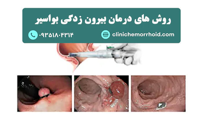 روش های درمان بیرون زدگی بواسیر