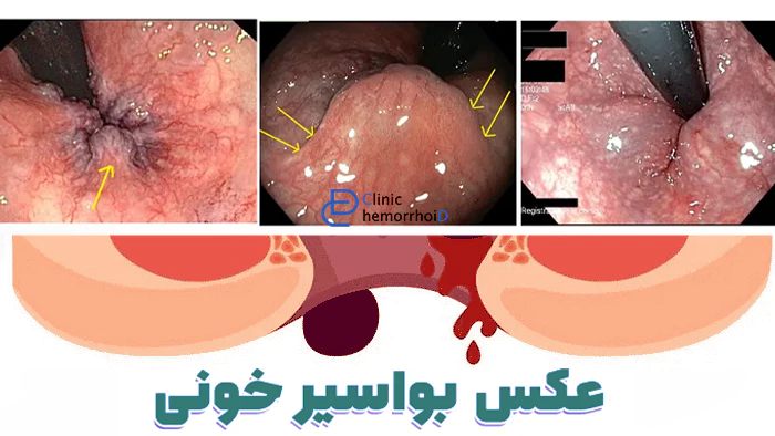 عکس بواسیر خونین