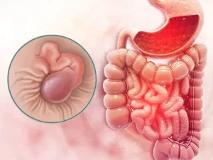هموروئید و سرطان روده