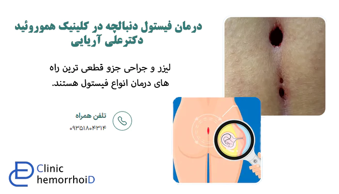 درمان فیستول دنبالچه