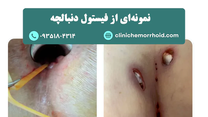 فیستول دنبالچه چیست