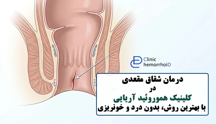 درمان شقاق مقعدی